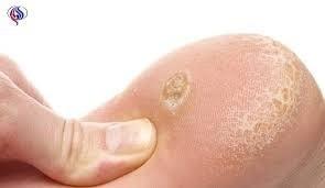 Crème De Pieds Soignante Pour Les Callosités Et Cors De Pieds 75ML